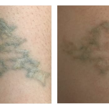 Erasable Med Spa - Post Session #1 - Tattoo Removal Near Me - Tampa, Florida Erasable Med Spa - Post Session #1 - Tattoo Removal Near Me - Tampa, Florida