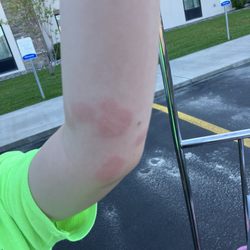 Son's arm covered in flea bites