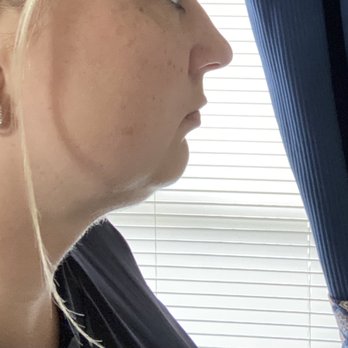 Jeff Healy, MD - 6 months post surgery (little to no change) - Cosmetic Surgeons Near Me - Aiea, Hawaii Jeff Healy, MD - 6 months post surgery (little to no change) - Cosmetic Surgeons Near Me - Aiea, Hawaii