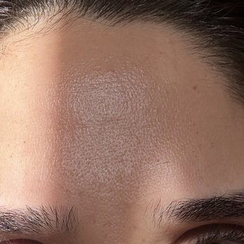 Renwee MedSpa - Smooth skin after botox injection - Medical Spas Near Me - Los Angeles, California Renwee MedSpa - Smooth skin after botox injection - Medical Spas Near Me - Los Angeles, California