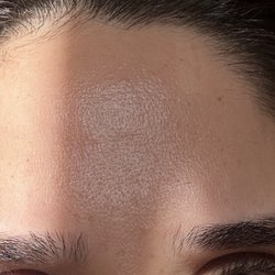 Renwee MedSpa - Smooth skin after botox injection