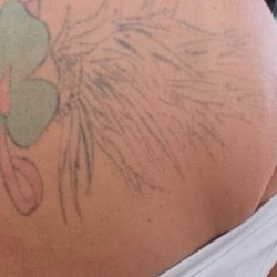 Vanish Laser Services - After 1 session #2