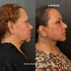 Batal Plastic Surgery