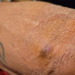 CSL Plasma - Hematoma, missed veins second time same hateful woman, this I don't think was a mistake