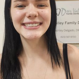 Post no prep veneers Post no prep veneers