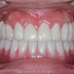 Lorena Alex, DDS, MSc - Semi-fixed Implant dentures