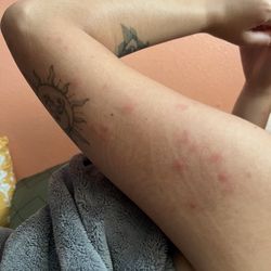 Elmwood Motel - Bed bug bites