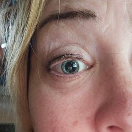 My eye post surgery