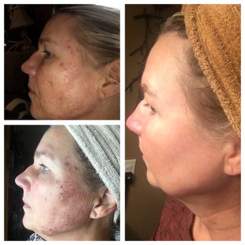 Facials & More Med Spa - Before and after of Skin Rejuvenation IPL getting rid of brown ( sun damage) on the face - Medical Spas Near Me - Lansing , Michigan