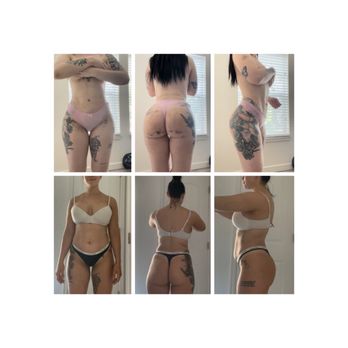 Spectrum Aesthetics - Bottom is before. Top is 1 week post op - Medical Spas Near Me - Miami, Florida Spectrum Aesthetics - Bottom is before. Top is 1 week post op - Medical Spas Near Me - Miami, Florida