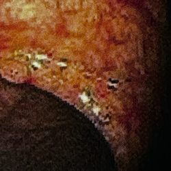 Jaffrey Kazi, MD - Polyps Thank You Dr. Kazi for removing these in my 50's before I ended up with cancer.