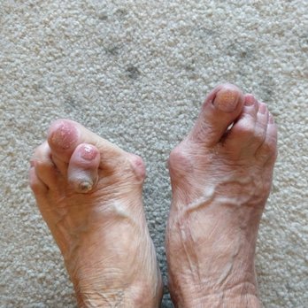 Nail's Paradise and Spa - If that toe weren't so icky, these feet would be cute! Thanks to Nails Paradise! - Nail Salons Near Me - San Diego, California