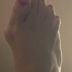 Dollard Mark, DPM - Before and after photos