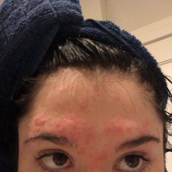 Diamond Nails - Acne after eyebrow wax - Nail Salons Near Me - Austin, Texas Diamond Nails - Acne after eyebrow wax - Nail Salons Near Me - Austin, Texas