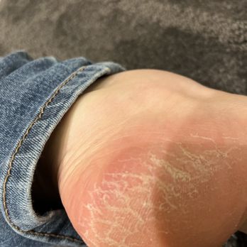 Fingers and Toes - Same day after a pedicure. - Nail Salons Near Me - Greenbrae, California