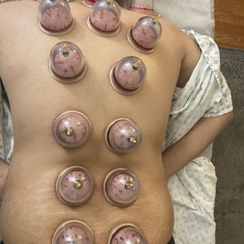 Hijama Cupping Therapy - Hijama removes toxins and heat right away - Massage Therapy Near Me Hijama Cupping Therapy - Hijama removes toxins and heat right away - Massage Therapy Near Me