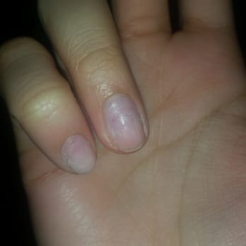 Unique Nails Tacoma - About 1/4 of the way down from my cuticles you can see the demarcation of damage by the half moon shape. - Nail Salons Near Me - Tacoma, Washington Unique Nails Tacoma - About 1/4 of the way down from my cuticles you can see the demarcation of damage by the half moon shape. - Nail Salons Near Me - Tacoma, Washington