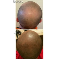 Utah Scalp Micropigmentation Center - Scalp micropigmentation, Hair replacement tattoo
