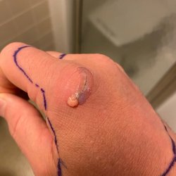 Martha Morehouse Medical Plaza - My second day in the hospital. The infection broke through the liquid stitches.