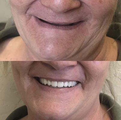 Before and After - From simple to complex cases, we create stunning smiles with our state of the art technology and world class solutions. Before and After - From simple to complex cases, we create stunning smiles with our state of the art technology and world class solutions.