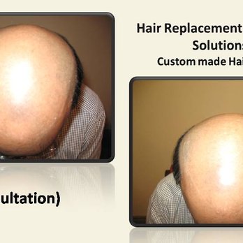 Simply Strandz - Before application - Hair Loss Centers Near Me - Toronto, Ontario