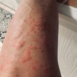 West Marion Community Hospital - Allergic reaction to penicillin which I diagnosed! Stayed an hour or two! Got steriods and benedyl!!!