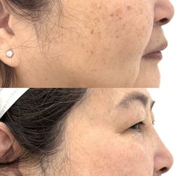 Phi MD Aesthetics - After 2 treatments of laser