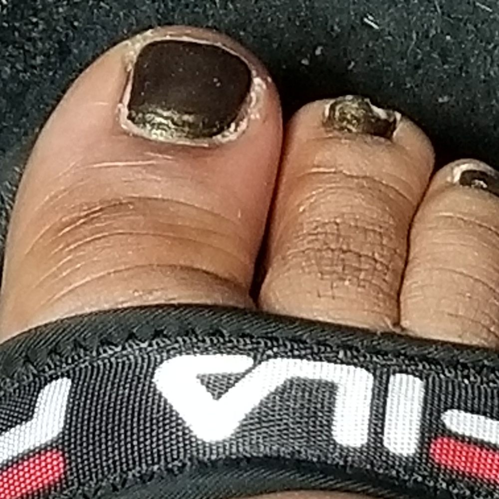 Natural Nails Spa - Close up pic of my toe. You can see the swelling around the nail bed. - Nail Salons Near Me - Jessup, Maryland Natural Nails Spa - Close up pic of my toe. You can see the swelling around the nail bed. - Nail Salons Near Me - Jessup, Maryland