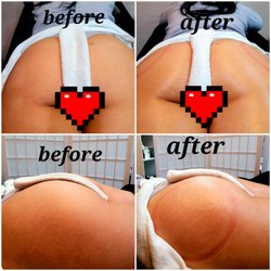 Vacuum booty lift