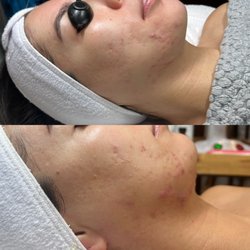 Faces By Noelle Kirsten - Before /After 3 months of Face Reality Treatments & acne Program