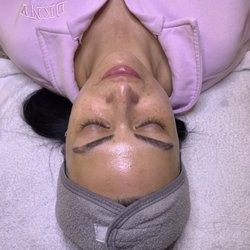 Acne Specialists of Walnut Creek - My skin, she's glowing