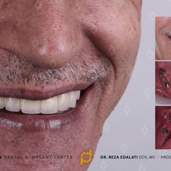 Reza Edalati, DDS - Precision Dental & Implant Center - Full Mouth Restoration & Dental Implant