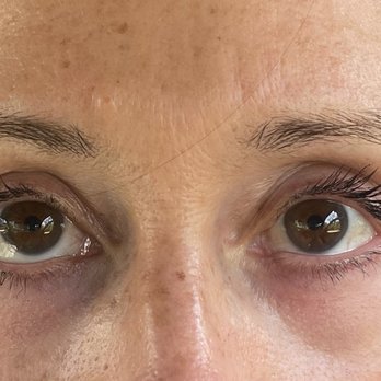 Maziar Bidar, MD - After - Cosmetic Surgeons Near Me Maziar Bidar, MD - After - Cosmetic Surgeons Near Me