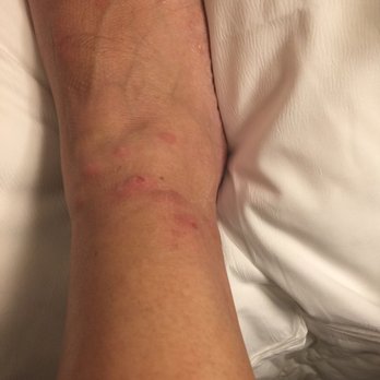 Residence Inn by Marriott Arlington - Flea bite from one night at the hotel!! - Hotels Near Me - Arlington, Texas Residence Inn by Marriott Arlington - Flea bite from one night at the hotel!! - Hotels Near Me - Arlington, Texas