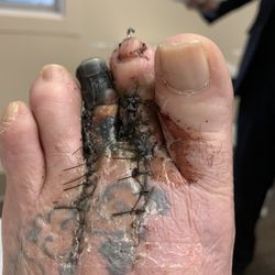 Mark E. Schakel, M.D. - Foot after surgery