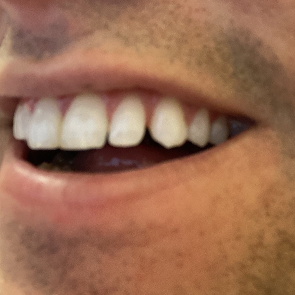 Peter J Lee, DDS - Before - Cosmetic Dentists Near Me - Irvine, California Peter J Lee, DDS - Before - Cosmetic Dentists Near Me - Irvine, California
