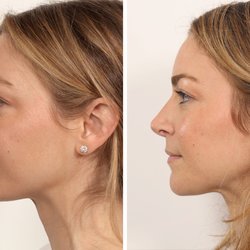 Benjamin Paul MD - Beautiful rhinoplasty result by Dr. Benjamin Paul