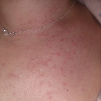 Salon l'Etoile - Rash from infection - Hair Salons Near Me - Jenkintown, Pennsylvania Salon l'Etoile - Rash from infection - Hair Salons Near Me - Jenkintown, Pennsylvania