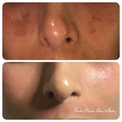 Elisha Marie Skin & Body - Melasma and Hyperpigmentation Treatment