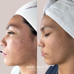 Angel Beauty Aesthetics - Our acne program for teens and adults.
