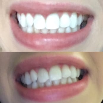 Element Dental & Orthodontics Tomball - Got a lot of work done ASAP!! Thanks you so much!! My smile was holding me back a lot but not anymore! - Cosmetic Dentists Near Me - Tomball, Texas
