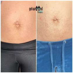 Sage and Silk Skin Studio - Fibroblast skin Tightening full stomach