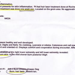 Rochester Laser Spa - Dermatologist report showing that my daughter was burned by Rochester Laser Spa