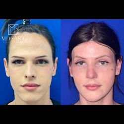 Artur Fahradyan, MD - MD Art Plastic Surgery - Facial Feminization