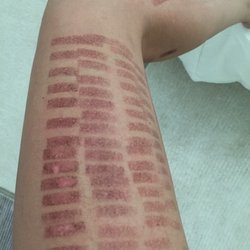 Spectrum Advanced Aesthetics School - My life was totally consumed by this for months so that I could heal and prevent scarring. scarring is now this exact horrific patchiness.