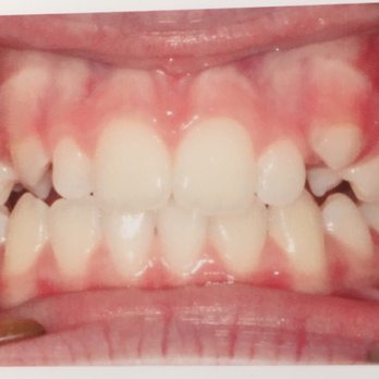 Updike Orthodontics - Before treatment - Orthodontists Near Me - Irvine, California