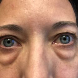 Valley Ophthalmic Facial Plastic Surgery - Before procedure - no makeup