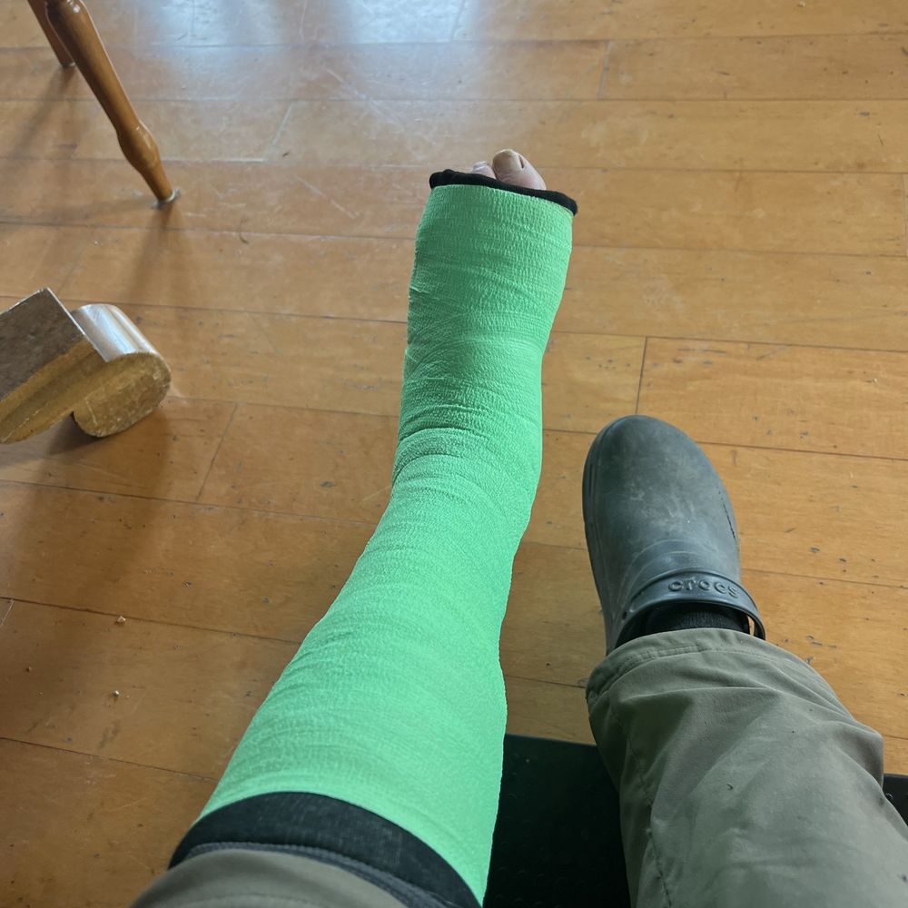 Ponte Physical Therapy - My ruptured Achilles tendon splint - Physical Therapy Near Me - Eureka, California Ponte Physical Therapy - My ruptured Achilles tendon splint - Physical Therapy Near Me - Eureka, California