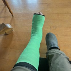 Ponte Physical Therapy - My ruptured Achilles tendon splint