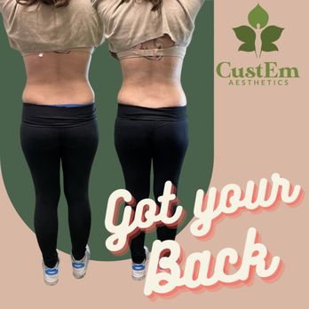 CustEm Aesthetics - Back body Sculpting - Body Contouring Near Me - Fremont, California CustEm Aesthetics - Back body Sculpting - Body Contouring Near Me - Fremont, California